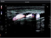 Дуплексное сканирование артерий конечностей