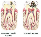 Лечение кариеса