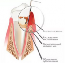Пародонтология (лечение десен)