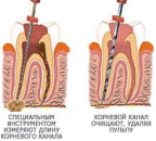 Лечение каналов зуба