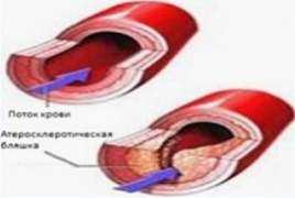 Допплерография периферических сосудов